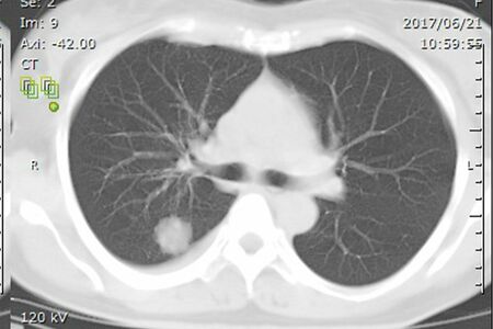 松本みゆきさんが見ても、すぐに「肺がんだ」とわかったというCT画像。白い影がはっきりと写り込む