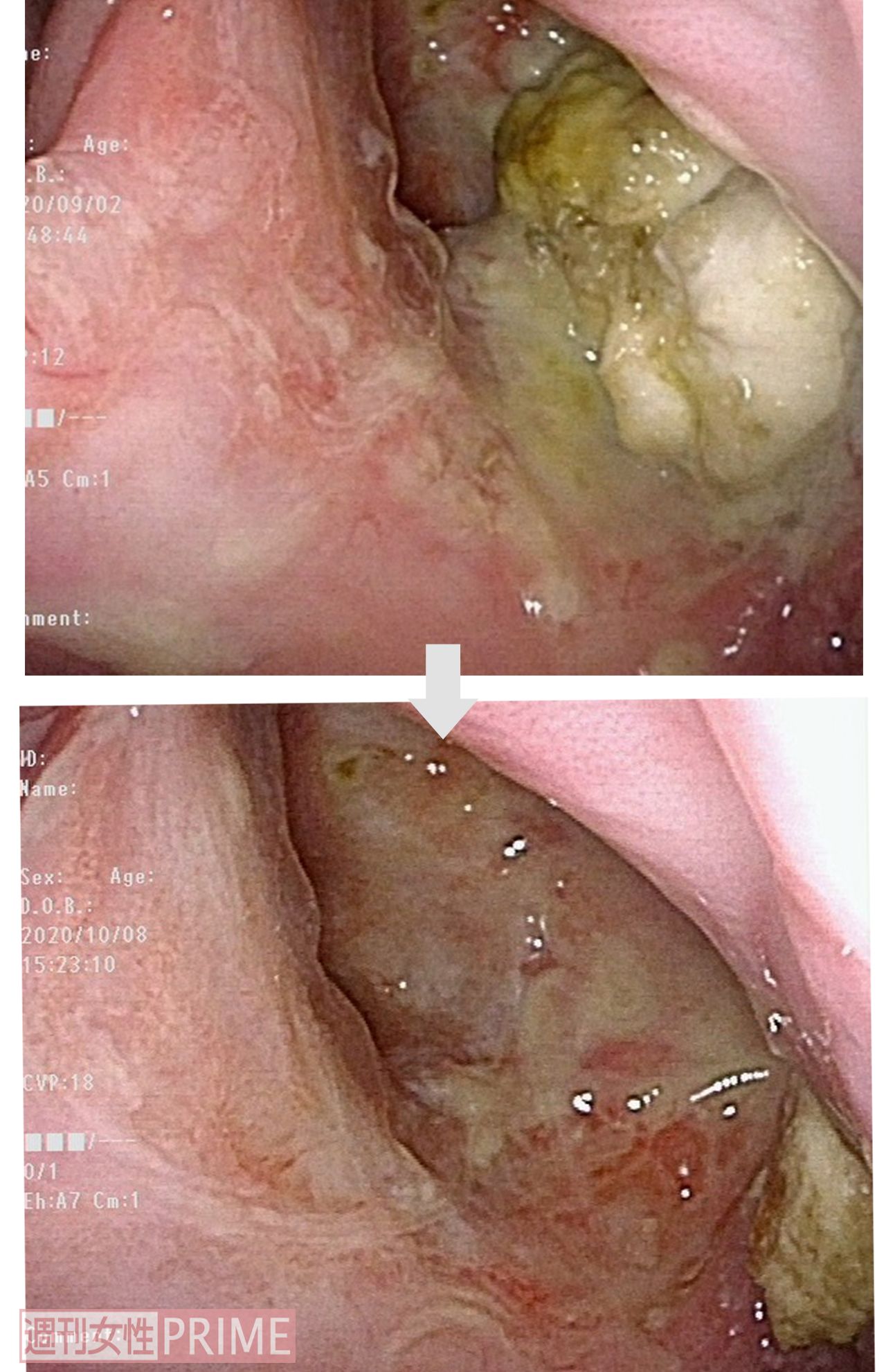 【症例1：70代男性 左上顎洞がん】内視鏡で見たBNCT治療前後の様子。溶けるようにがんが消失