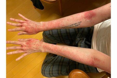 抗がん剤治療の副作用で皮膚障害が出て、両腕に赤い発疹が