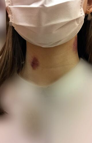 山本亮太による性行為中の暴力行為により、Aさんの身体には、いたるところに痛々しいあざがつけられていた