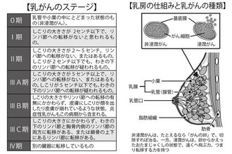 乳がんの最新治療　がんのサブタイプが治療法選択の有力情報