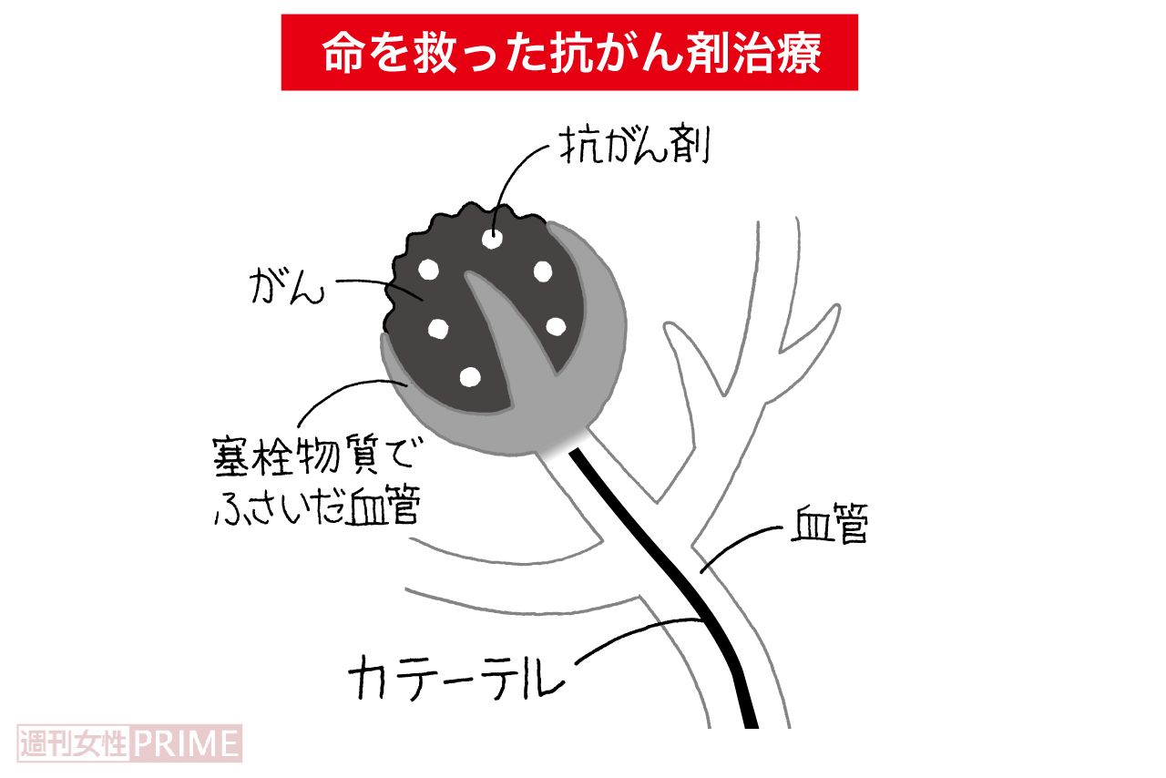 「動脈化学塞栓療法」という抗がん剤の局所療法。血管内に非常に細いカテーテルを通し、がんに向けて抗がん剤を送り込むと同時に、がん組織が栄養を受け取る血管をふさぐ治療法