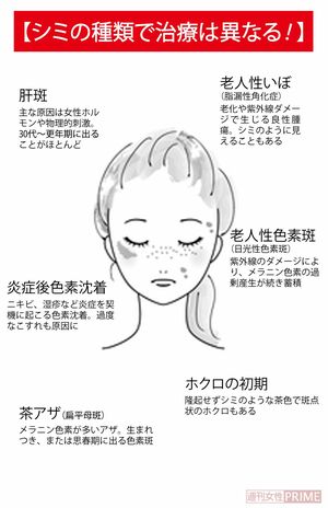 【シミの種類で治療は異なる！】