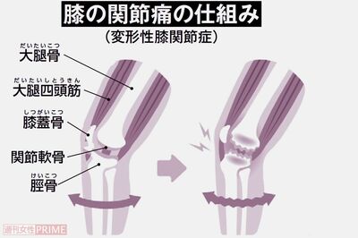 梅雨どきに気になる関節痛が男性よりも女性が2.3倍も多いのは更年期が関係、予防のキーは体重管理と筋力「…