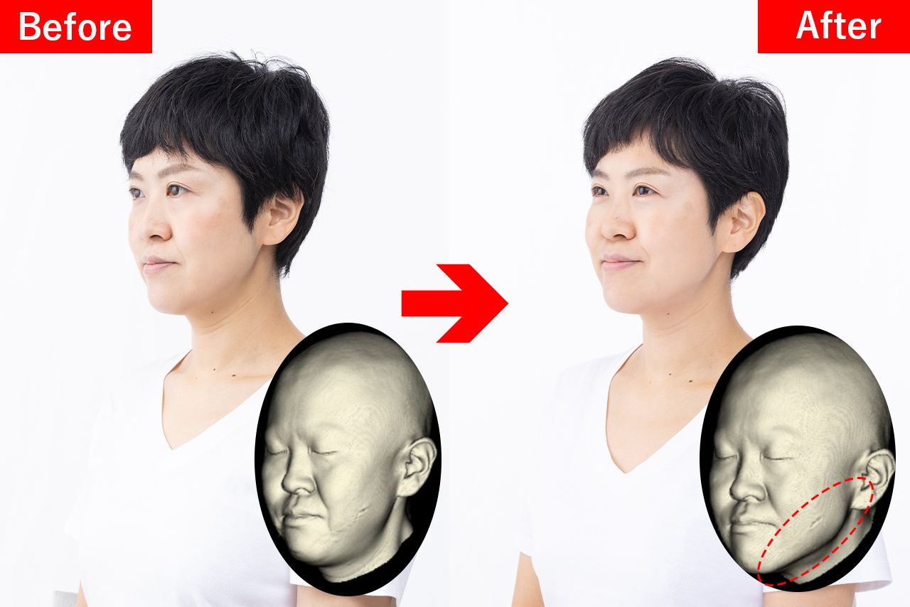 1か月実践したAさん（40代）※画像は『すぐ実感！「マイナス10歳」カオキン体操』（青志社）より