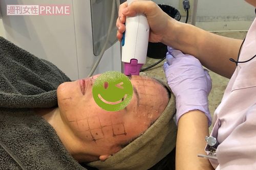 くまなく照射するため、顔にマス目ををつける（施術後にきれいに消してくれるのでご安心を）。さらに、肌の奥の層まで電気の通りをよくするための専用ジェルを塗布