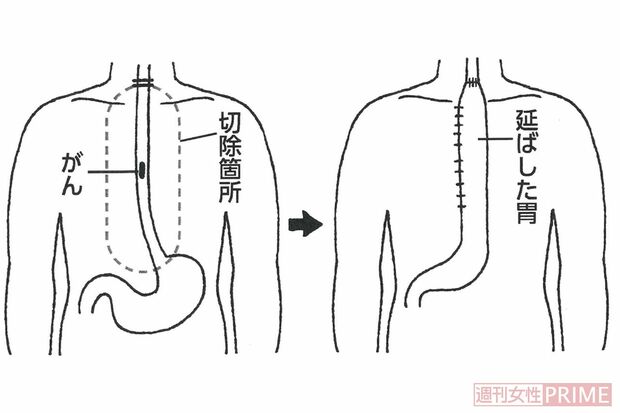 食道がんの手術、こんなに大変！（1）胸部食道がんの場合、のど、胸、お腹と3つの領域にわたって切り開き、食道を切除する（2）胃を管状にして残った食道とつなげる。管は大腸や小腸で代用も（イラスト／小島サエキチ）