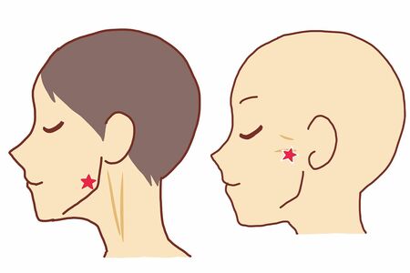 右図の★が「下関」という頬のくぼみにある、歯や歯茎の痛みを緩和するツボ。左図の★が、歯を食いしばるときに出っ張る部分の、同じく痛みを軽減させるツボの「頬車」