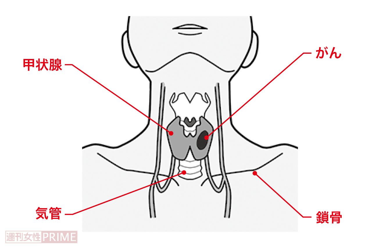 甲状腺がんの位置　イラスト／青井亜衣