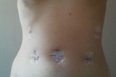 術後の様子。お腹に手術痕がいくつも