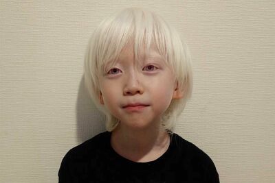 2万人の1人の指定難病『アルビノ』を抱える小学生のりっくん、母が語った息子への愛「個性は宝物」