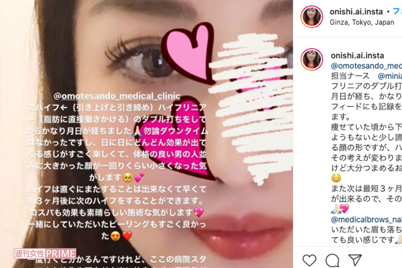 「ハイフ」などの美容技術によって、輪郭を綺麗にしたという愛さん