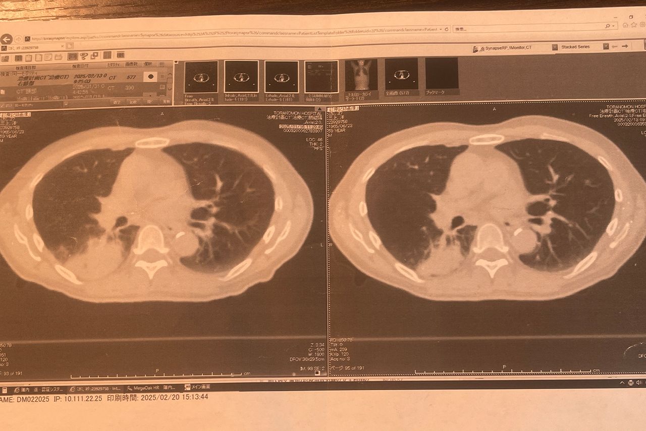肺がんの治療前とその後。MRI、エックス線でもやや小さくなったことを確認。放射線治療など計画を変えてがんを弱める可能性も