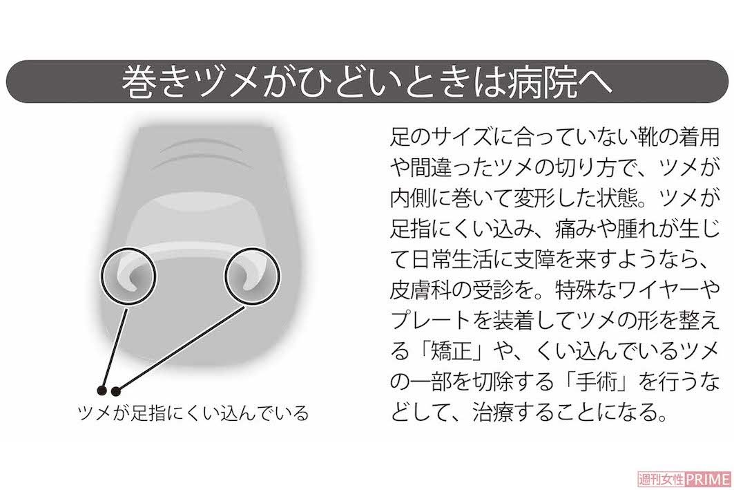 巻きヅメがひどいときは病院へ