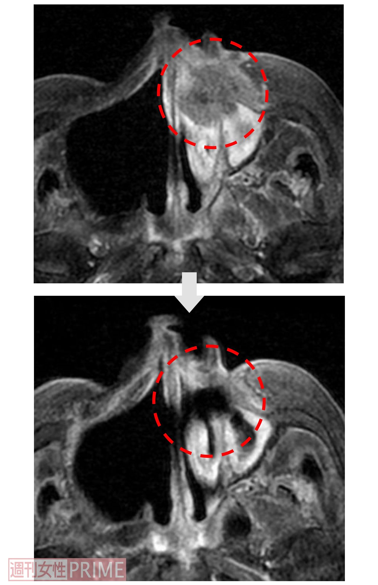【症例2：80代女性 上顎歯肉がん】BNCT治療前後の画像