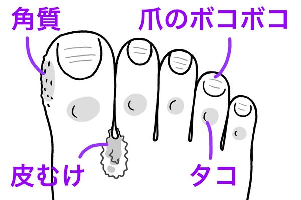 足のトラブル