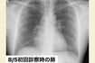8月5日、「東京都発熱相談センター」で紹介された病院でのレントゲン写真。まだ肺はキレイだった(写真:取材者提供/東洋経済オンライン)