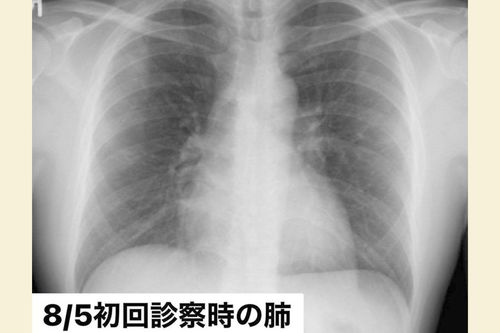 8月5日、「東京都発熱相談センター」で紹介された病院でのレントゲン写真。まだ肺はキレイだった（写真：取材者提供／東洋経済オンライン）