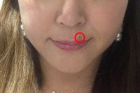 高須クリニックで“ババ見えホクロ”を取ってみた「びっくりするほど短時間で、痛みがない!」