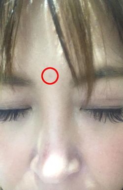 眉間のホクロはほとんどわからない状態に