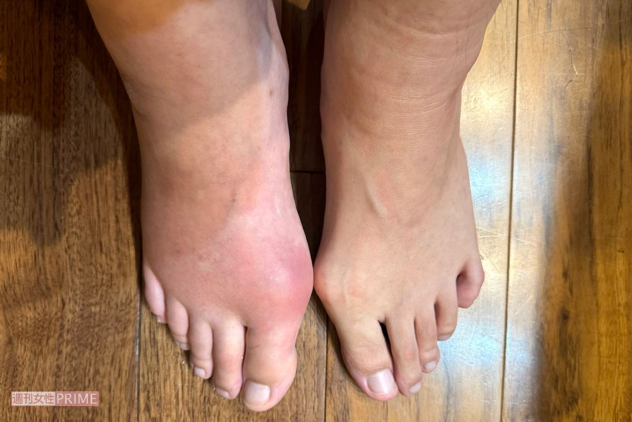 痛風発症後の両足の写真。右足が大きく腫れ激痛が走った　写真提供／古坂大魔王さん