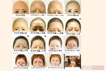 ラスケモとは「ラスト毛もっと」の略で最後の抗がん剤治療のことを指す言葉　　　提供／さくらさん