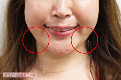 両頰の下の肉が気になる……