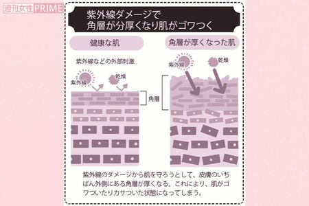 紫外線ダメージで角層が分厚くなり肌がゴワつく