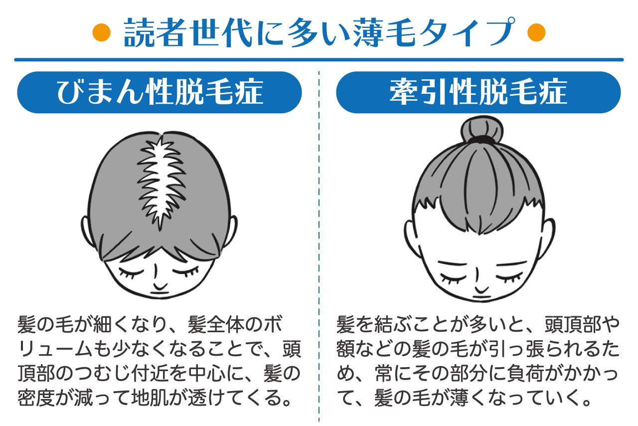 女性に多い脱毛症はこのふたつ　イラスト／はやかわくにこ