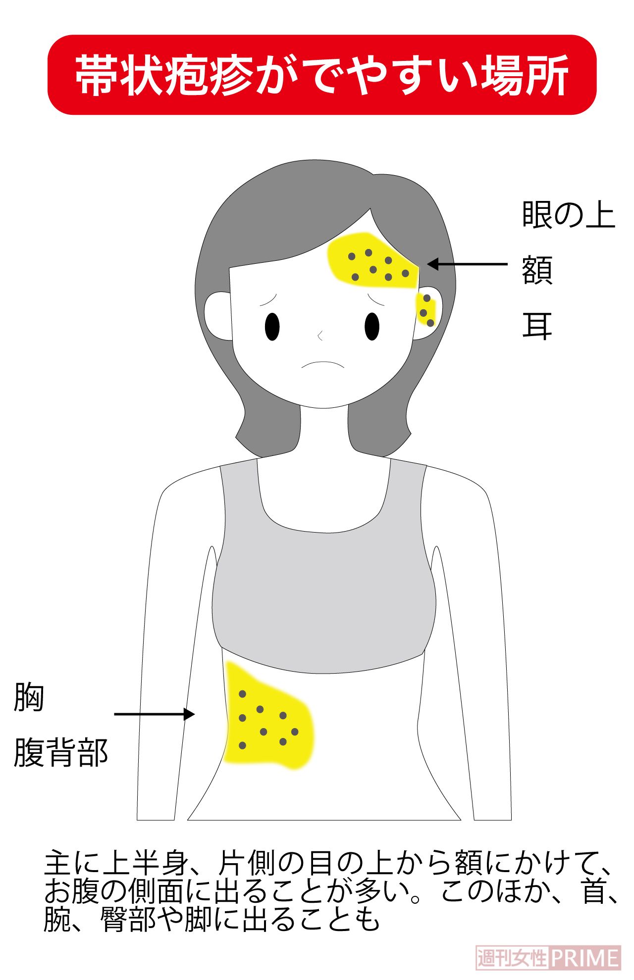 主に上半身、片側の目の上から額にかけて、お腹の側面に出ることが多い。このほか、首、腕、臀部や脚に出ることも（イラスト／ますみかん）