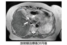 放射線治療後3か月では、ほとんどがんが見えなくなっている（画像提供:GenesisCare）