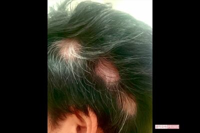 国立国際医療センターの調査では、後遺症が現れるのは感染者の約1割。女性によく見られる症状のひとつが頭髪の脱毛