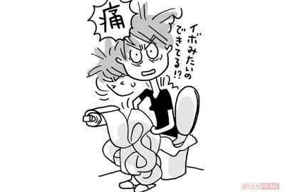 3人に1人は“痔主”という恐ろしい真実！手術を行わず治すための「7つのルール」