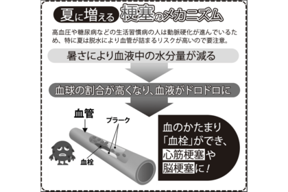 夏に増える梗塞のメカニズム