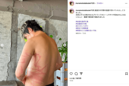 クラゲに刺されてしまったことを報告するウーマンラッシュアワーの村本大輔（公式インスタグラムより）