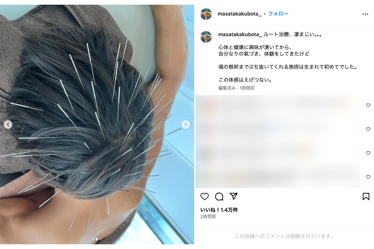 “ルート治療”を受ける窪田正孝。過激すぎるため、一部写真が“不適切なコンテンツ”扱いに（本人インスタグラムより）