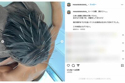 “ルート治療”を受ける窪田正孝。過激すぎるため、一部写真が“不適切なコンテンツ”扱いに（本人インスタグラムより）