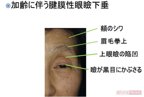 加齢にともなう腱膜性眼瞼下垂の症状　写真提供＝小室主任教授