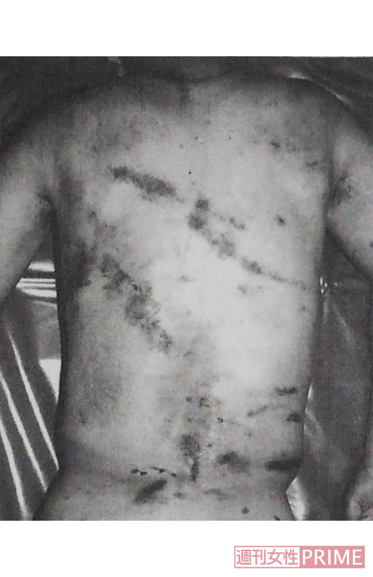 Aさんの遺体の背中には複数の大きなアザが生々しく残っていた