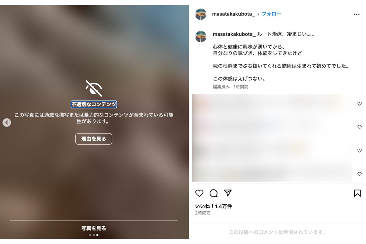 “ルート治療”を受ける窪田正孝。過激すぎるため、一部写真が“不適切なコンテンツ”扱いに（本人インスタグラムより）