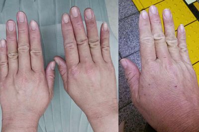 アトピーに悩む患者が多いのに、なぜヒスタグロビン治療が広まらないのか