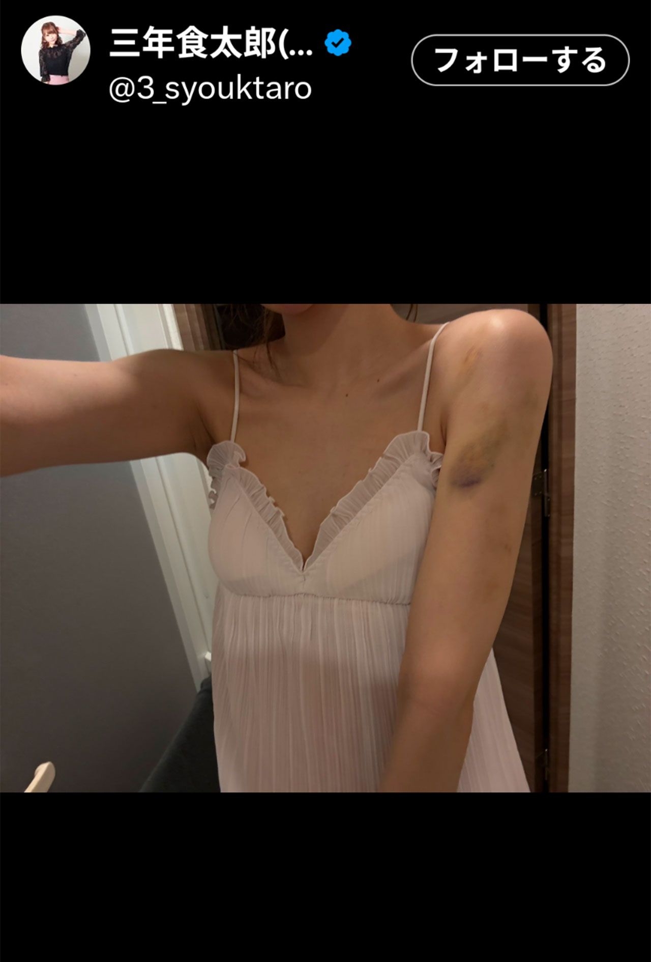 あざが痛々しい大食いYouTuberの三年食太郎（本人のXより）