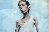 摂食障害とともに生きる「痩せ姫」たちの世界観、彼女たちが抱える “心の闇”