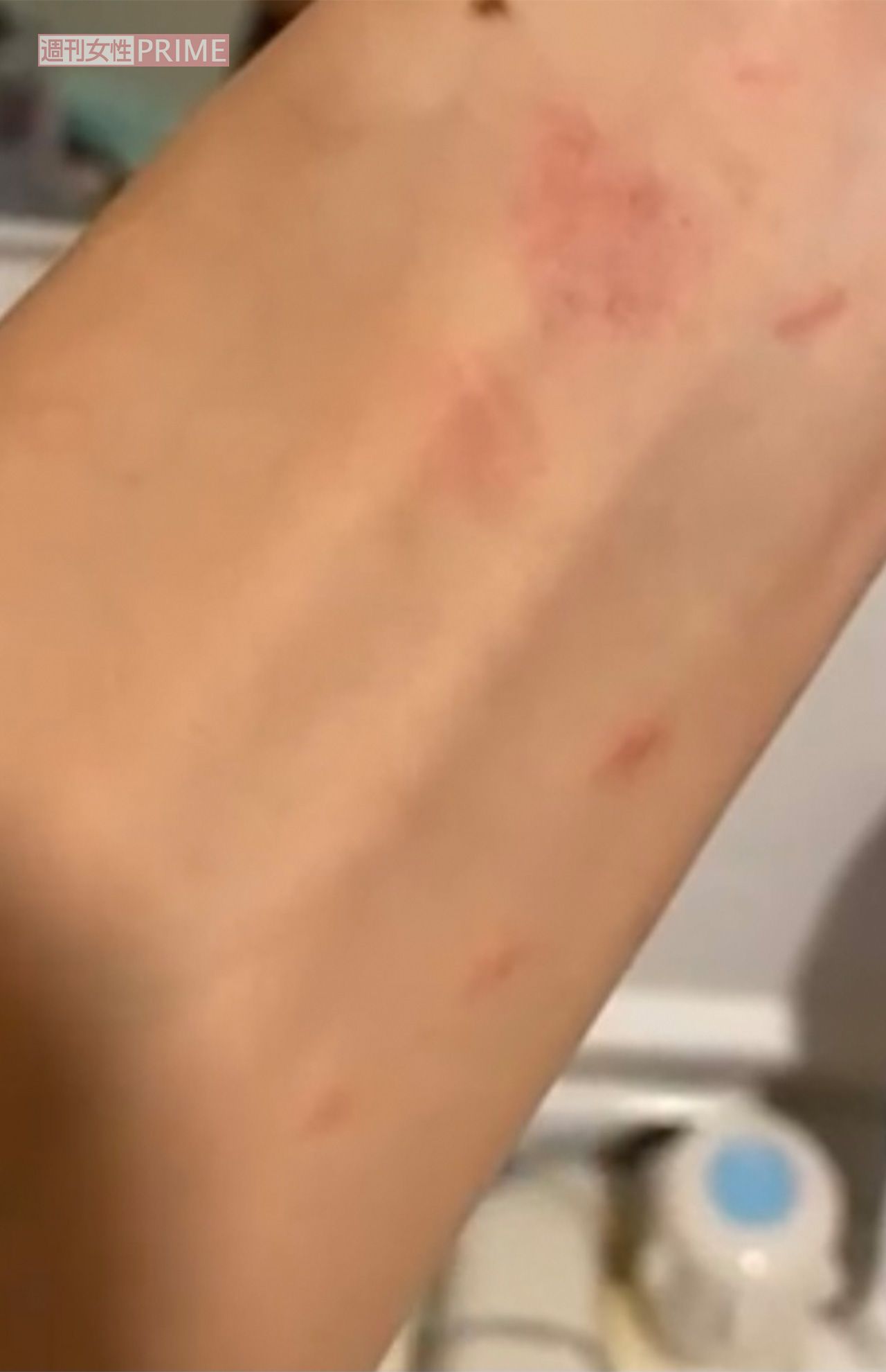 Ａ子からの暴力でできた、小澤の身体の傷1