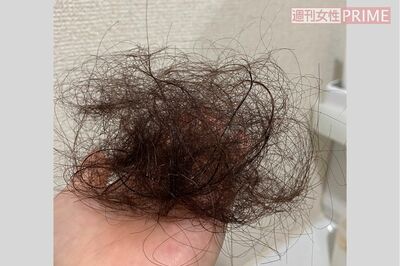 『コロナ後遺症』患者は推定50万人！ 30代女性の悲鳴「髪の毛が毎日ごっそり抜ける」
