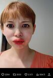 唇が腫れ上がって別人に見える(中川翔子のXより)