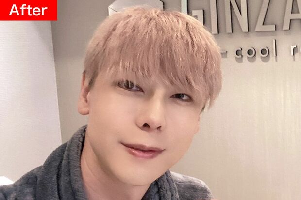 【After】優しげな目元がお気に入り！スマートな印象の顎のライン。目は二重にし、目の下の脂肪を移動。鼻は高さを出してシャープに。頬骨、えらの骨、顎の骨を削ってサイズダウン。