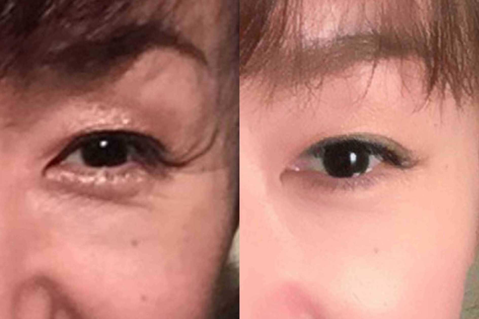 加藤ひとみさんの下で学び、49歳から顔ダンスを開始した松本さん。1年9か月後には目尻のシワが減り、目の下のたるみもスッキリ（左が49歳、右が51歳のとき）