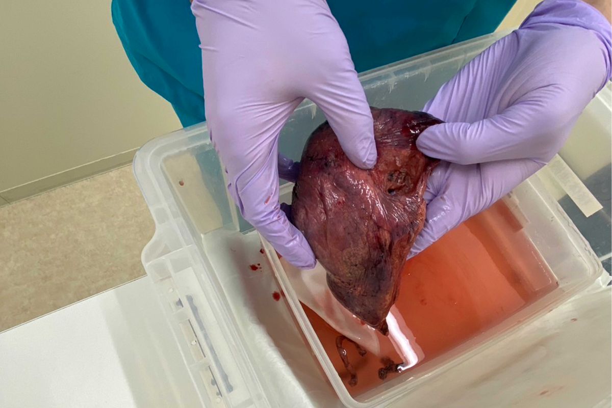 1割切除した自身の肺を「記念に撮ってもらいました」と笑顔で見せてくれた（本人提供）