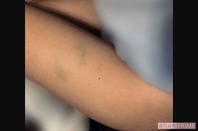 噛み跡がくっきり……